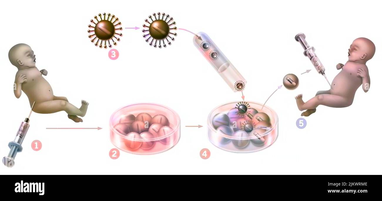 Gene therapy: introduction of retroviruses to modify mutated spinal cord cells of a newborn. Stock Photo