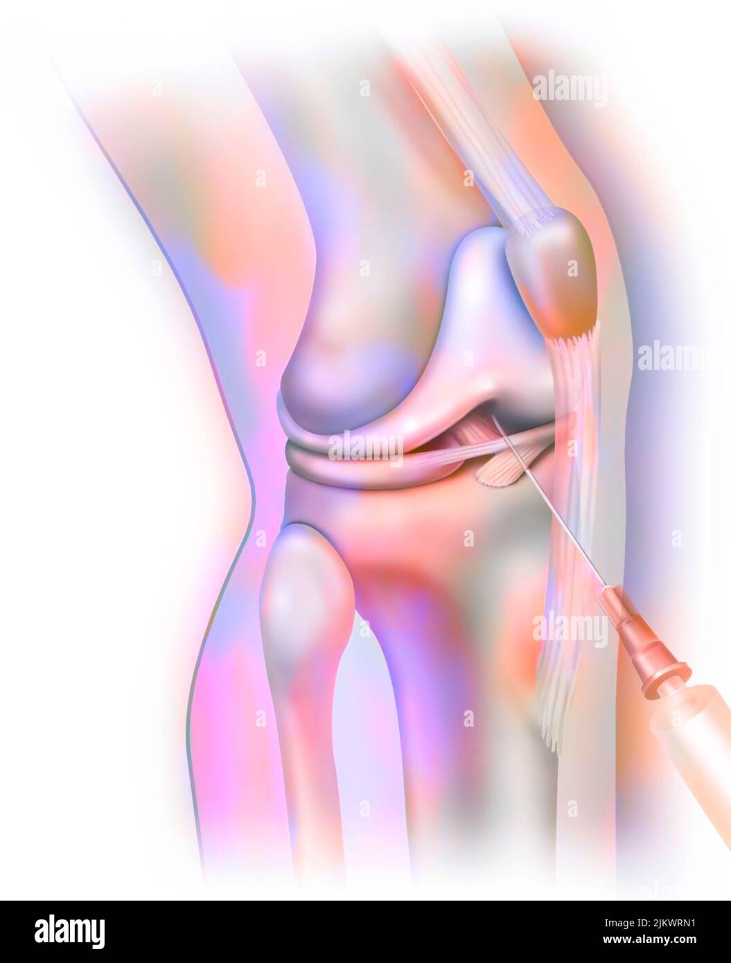 Knee joint, arthrography: injection of contrast product to make structures visible on the radio. Stock Photo
