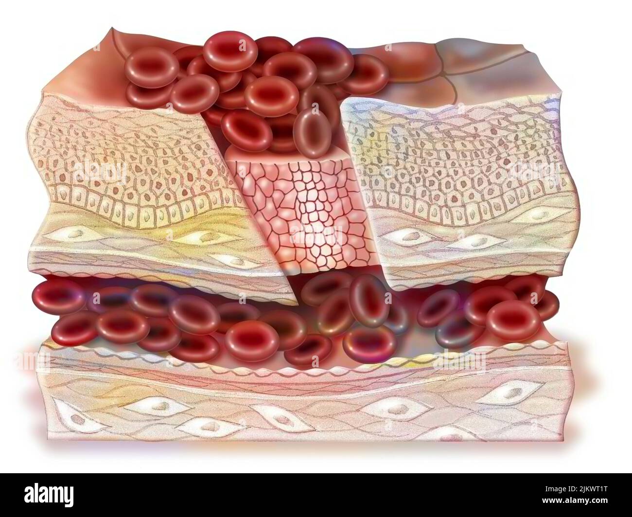 Intermediate phase of healing: the platelets have formed the platelet nail. Stock Photo