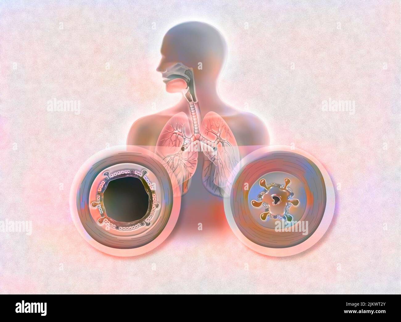 Comparison between healthy bronchi and bronchitis (acute bronchitis). Stock Photo