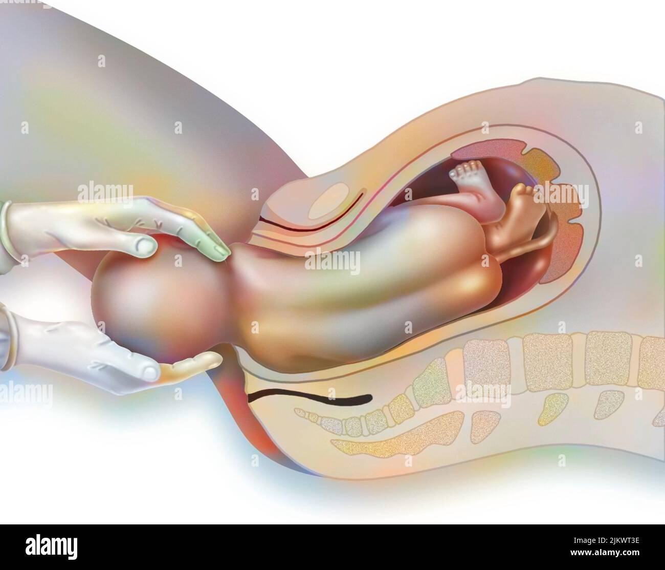 Childbirth, step 3: release of the upper shoulder by the midwife. Stock Photo