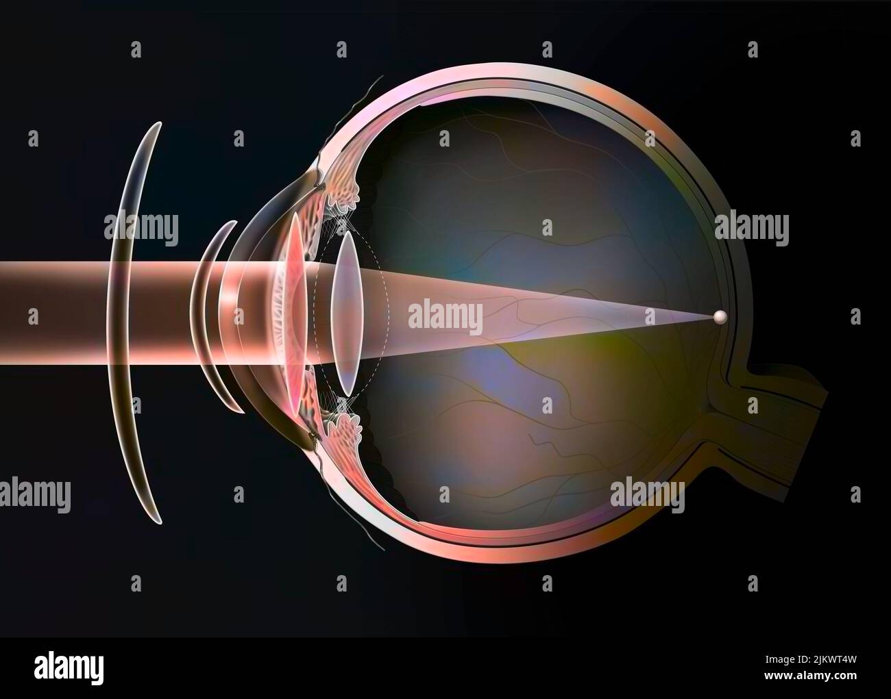 Different possible corrections of a presbyopic eye: spectacle lenses - external lenses. Stock Photo