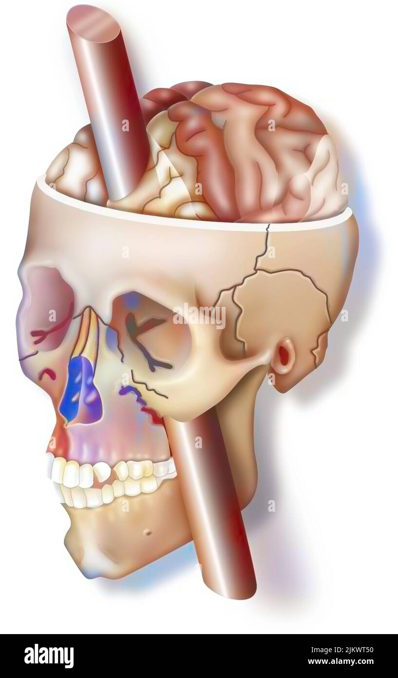 The frontal lobe: impact of the bar in Phineas Gage's skull on his emotions. Stock Photo