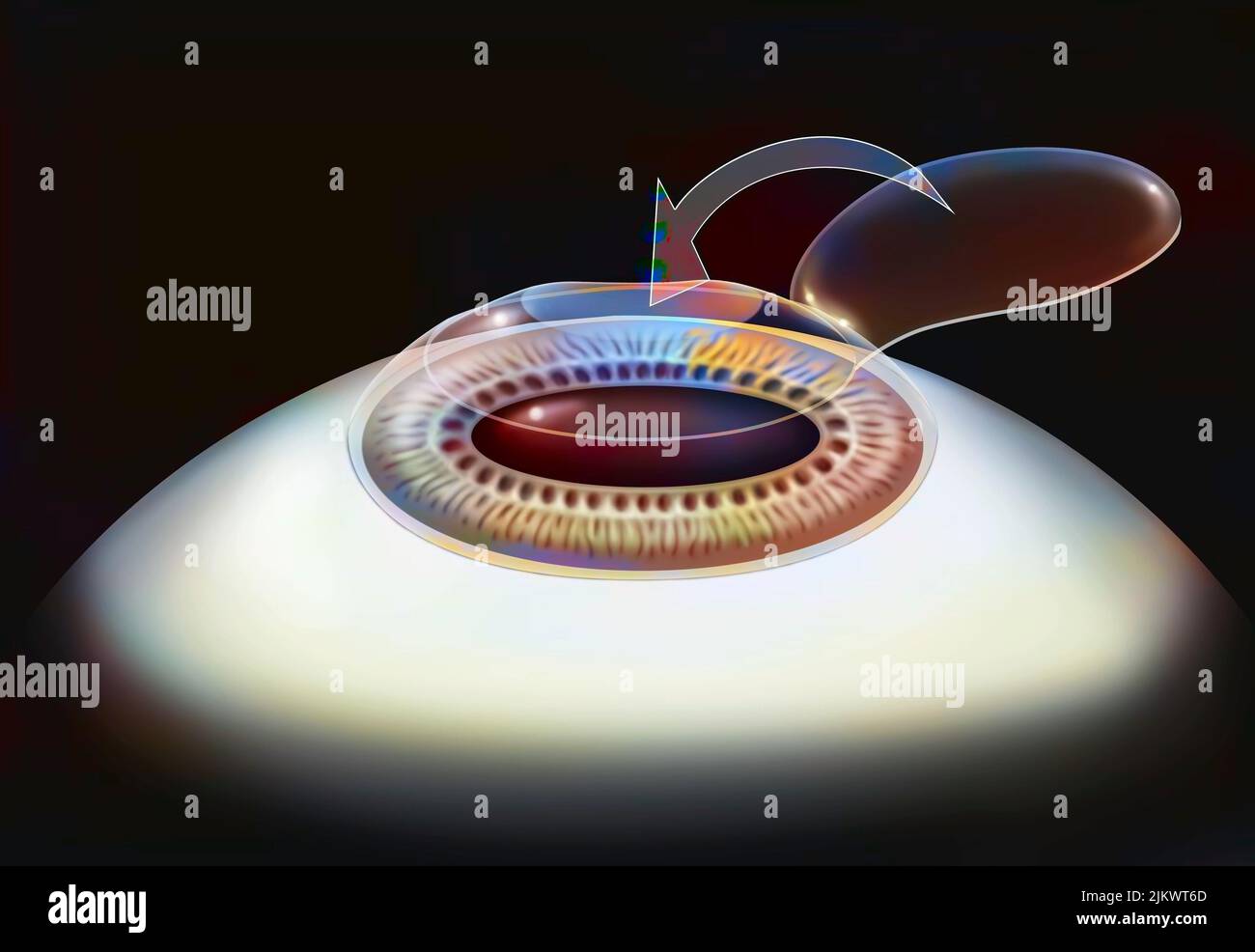 Eye, surgery, Lasik step 4 the corneal flap is put back in place Stock