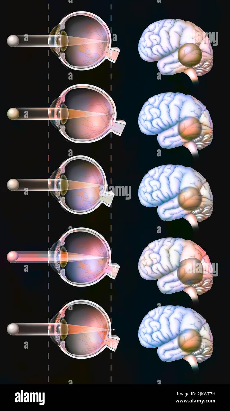 Eye: comparison between a normal eye and a myopic, hyperopic, astigmatic, presbyopic eye. Stock Photo