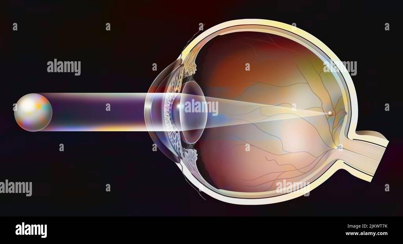 Nearsighted eye with image formation in front of the retina. Stock Photo