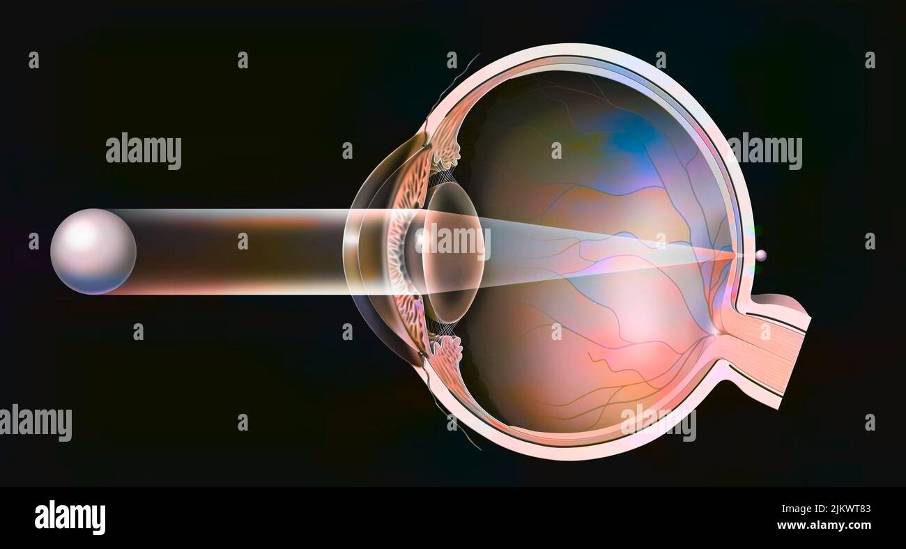 Hyperopic eye with the formation of the image behind the retina. Stock Photo