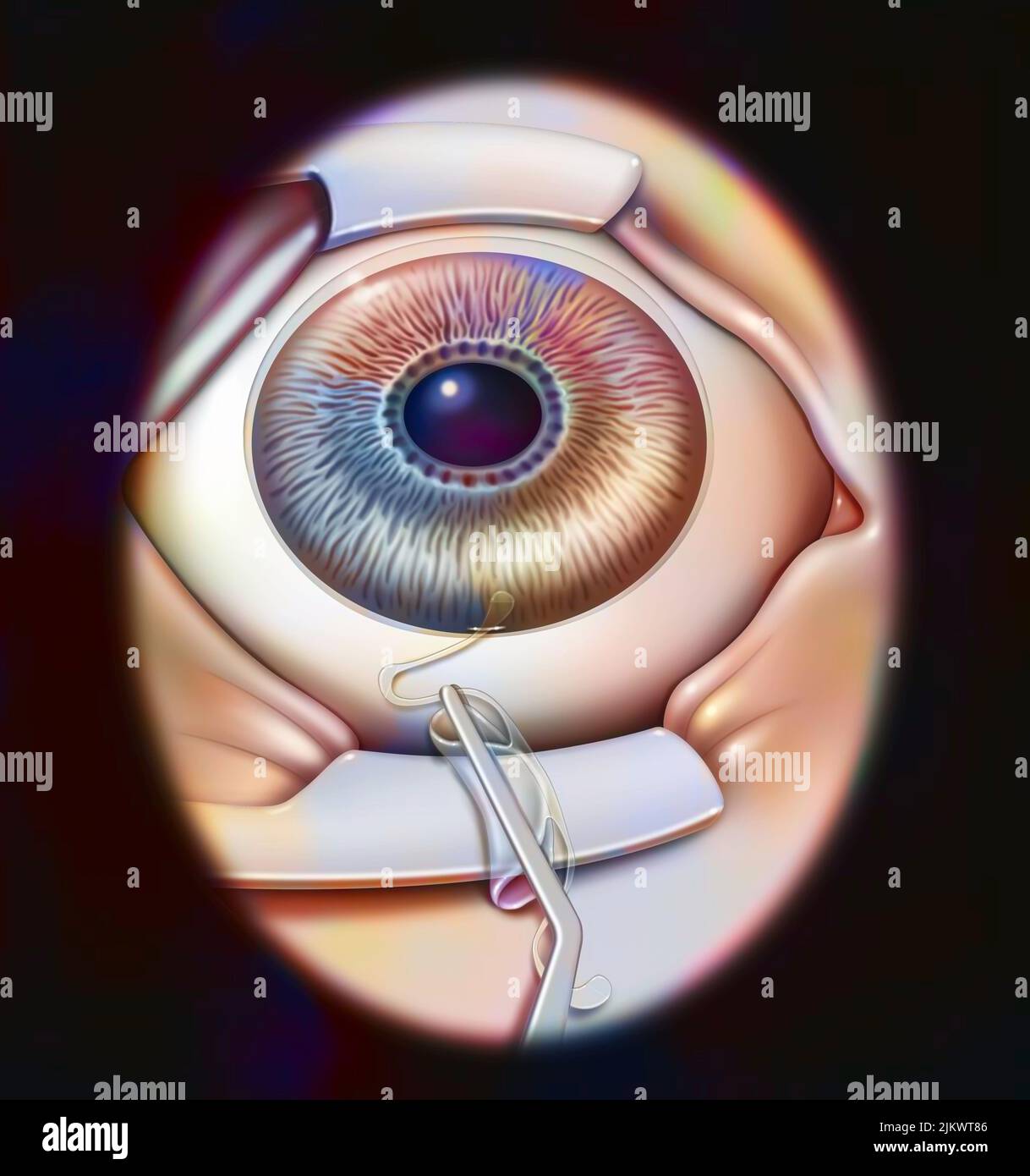 Intraocular implant, step 2 the implant is folded with forceps and
