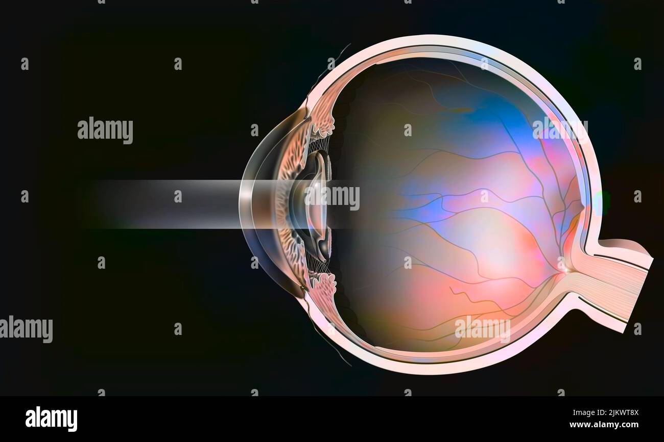 Sectional eye with secondary cataract treated with YAG laser. Stock Photo