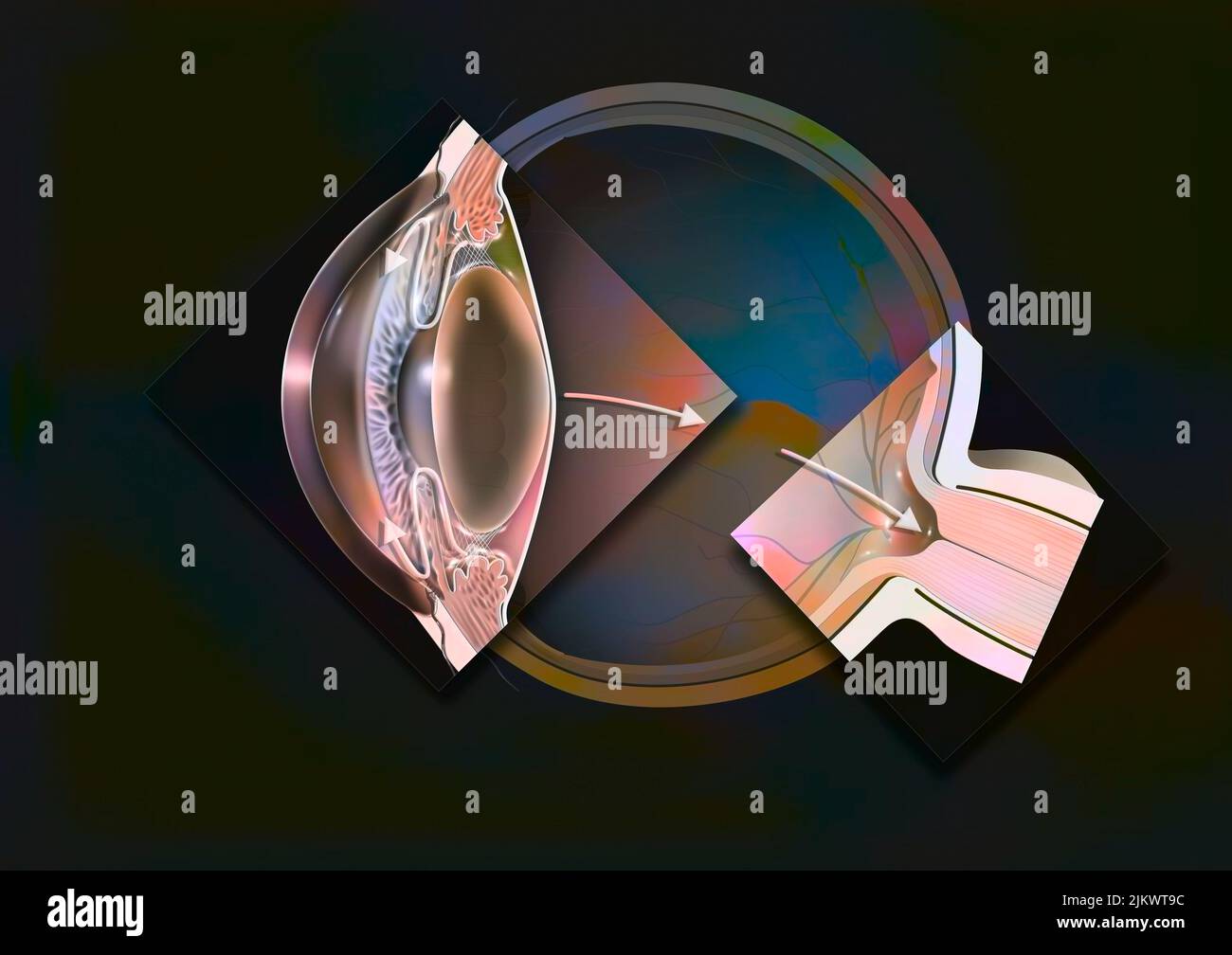 Glaucomatous eye with zooms of an open angle glaucoma and a glaucomatous papilla. Stock Photo