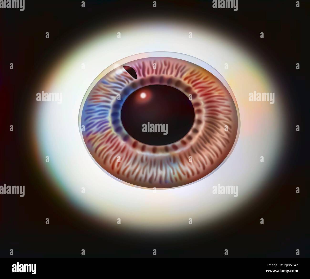 the iris of one eye to show the laser iridectomy procedure