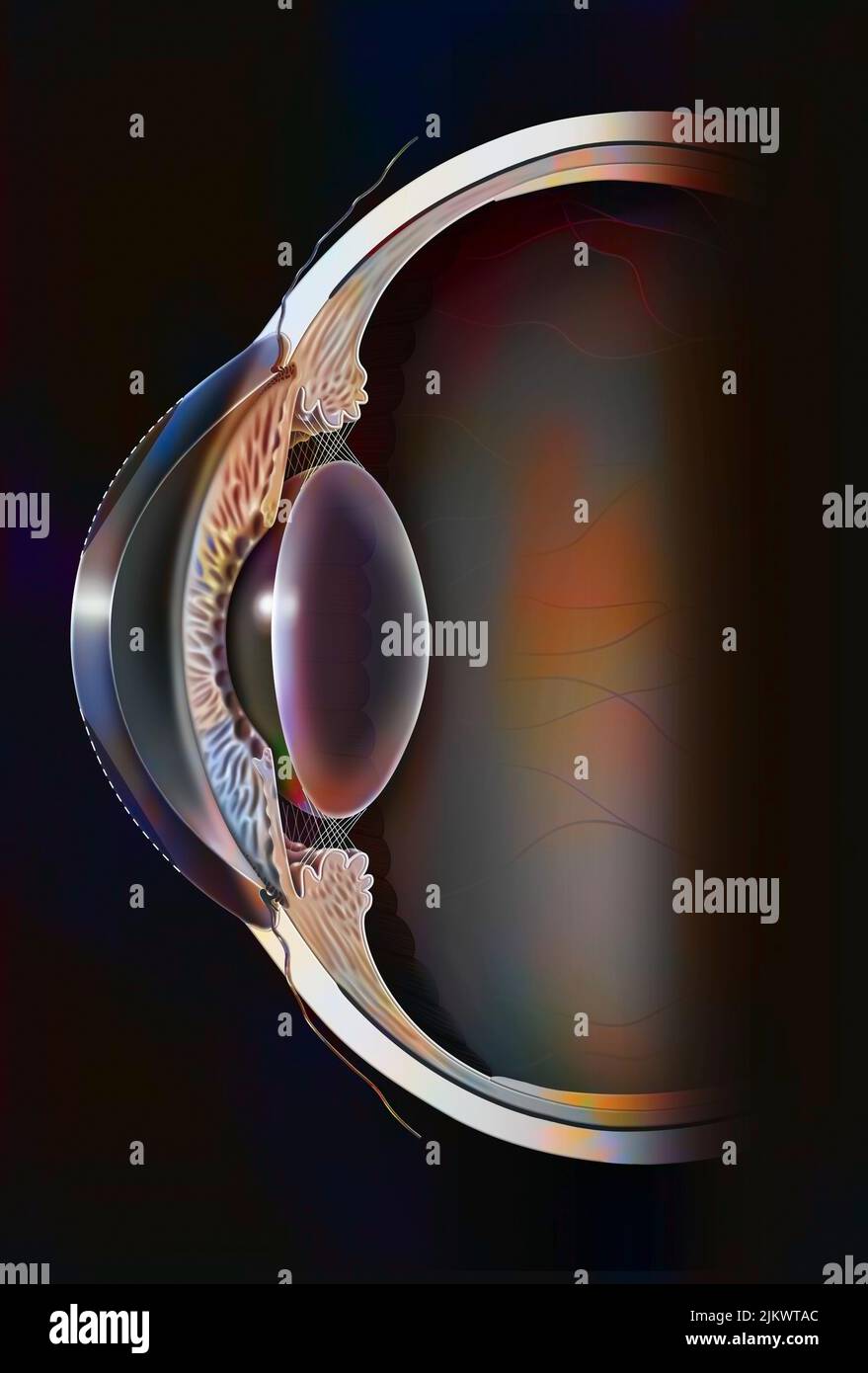 Eye surgery: refractive photokeratectomy in the case of a hyperopic eye. Stock Photo