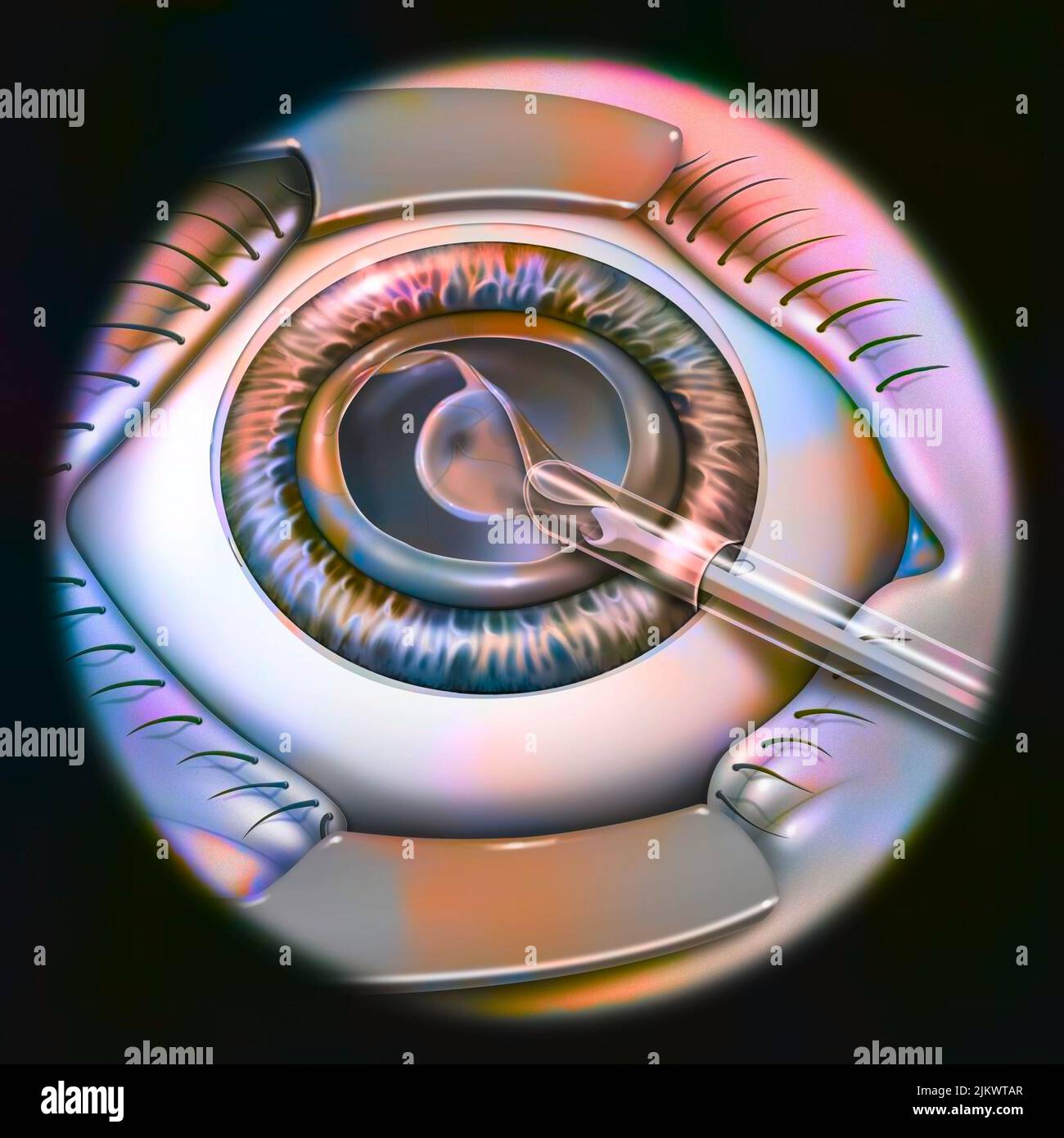 Eye, cataract, phacoemulsification step 3 placement of the implant