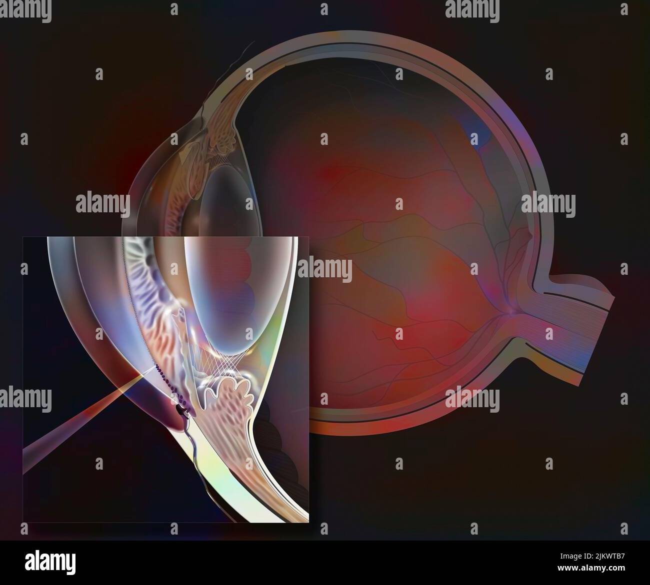 Glaucoma: glaucomatous eye with zoom on the operation of trabeculoplasty. Stock Photo
