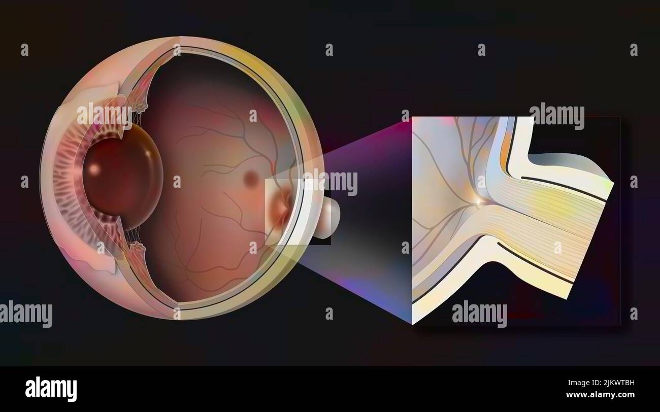 Normal eye with zoom on the papilla and the optic nerve. Stock Photo