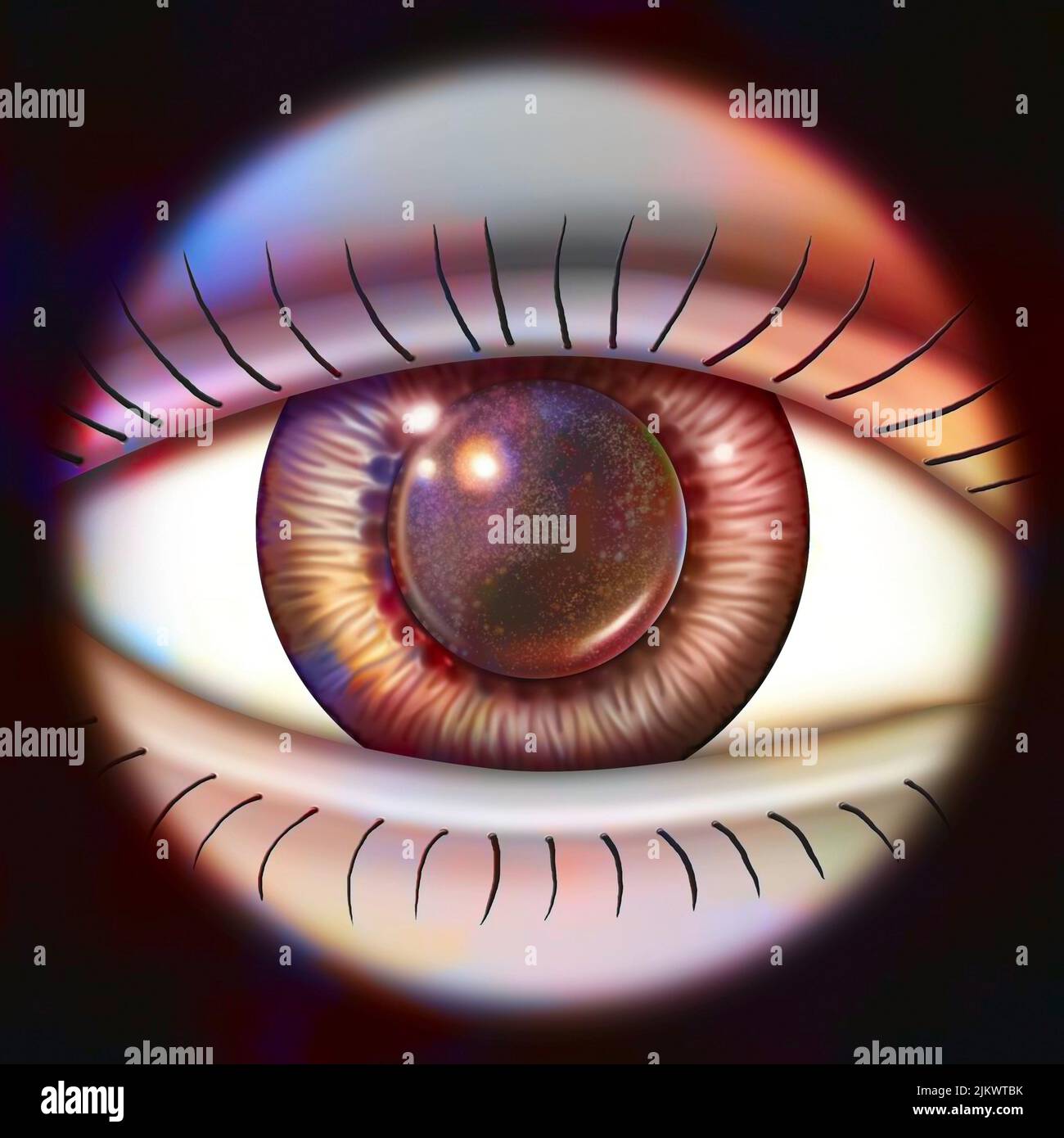 Eye (secondary cataract) clouding of the posterior lens capsule Stock Photo Alamy
