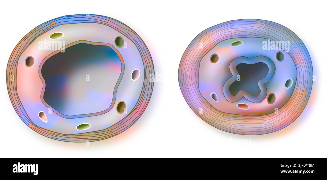 Asthma: healthy (left) and inflamed (right) bronchiole. Stock Photo