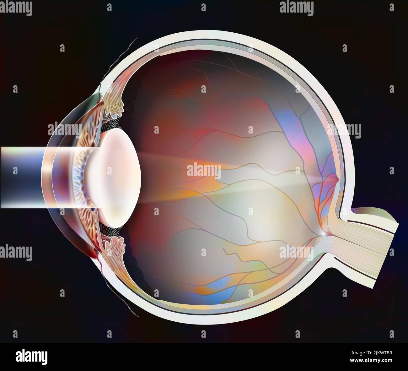 Eye: cataract with its cloudy, milky lens. Stock Photo