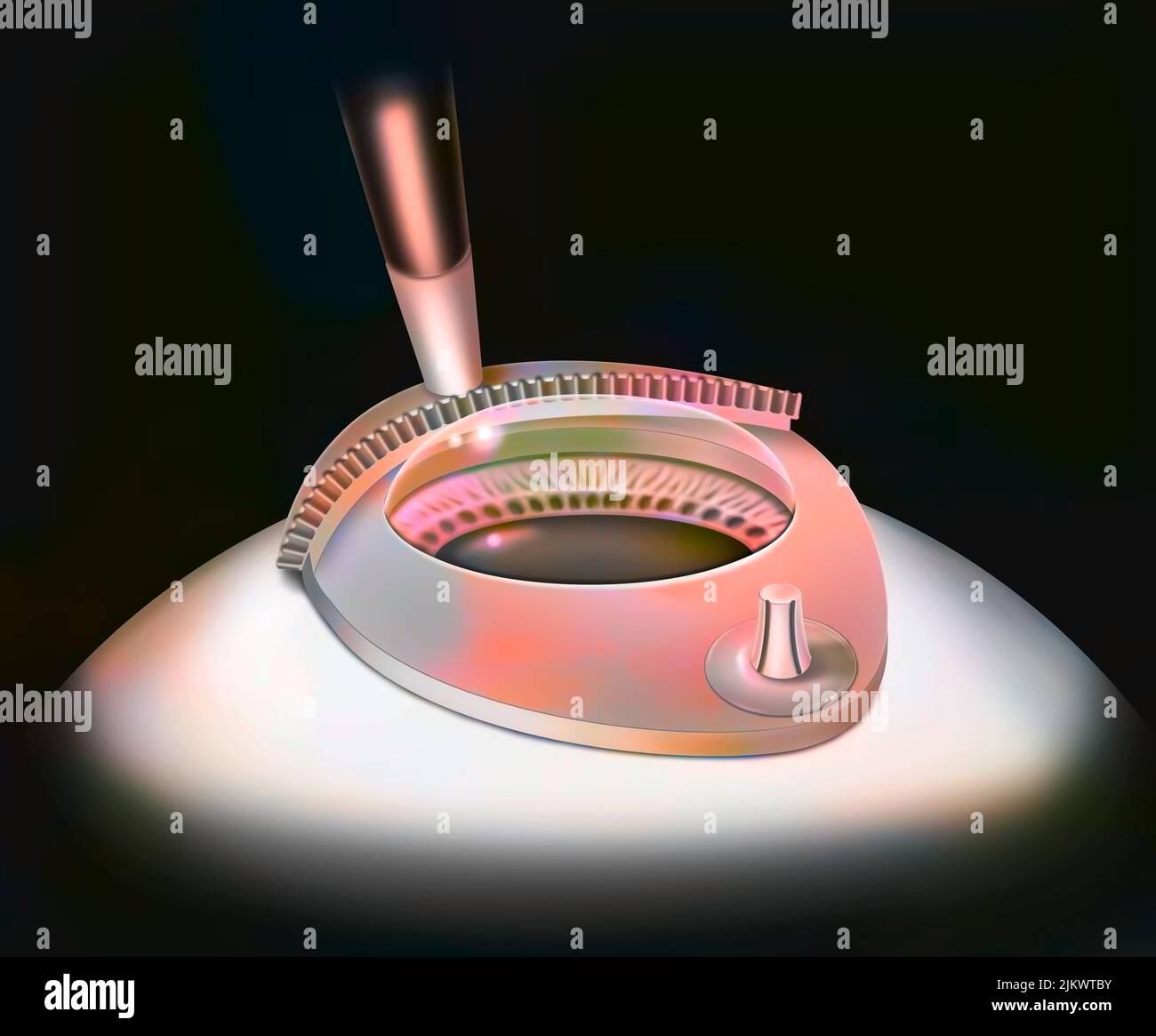 Eye, surgery, Lasik step 1: the microrobot is guided by a suction ring. Stock Photo