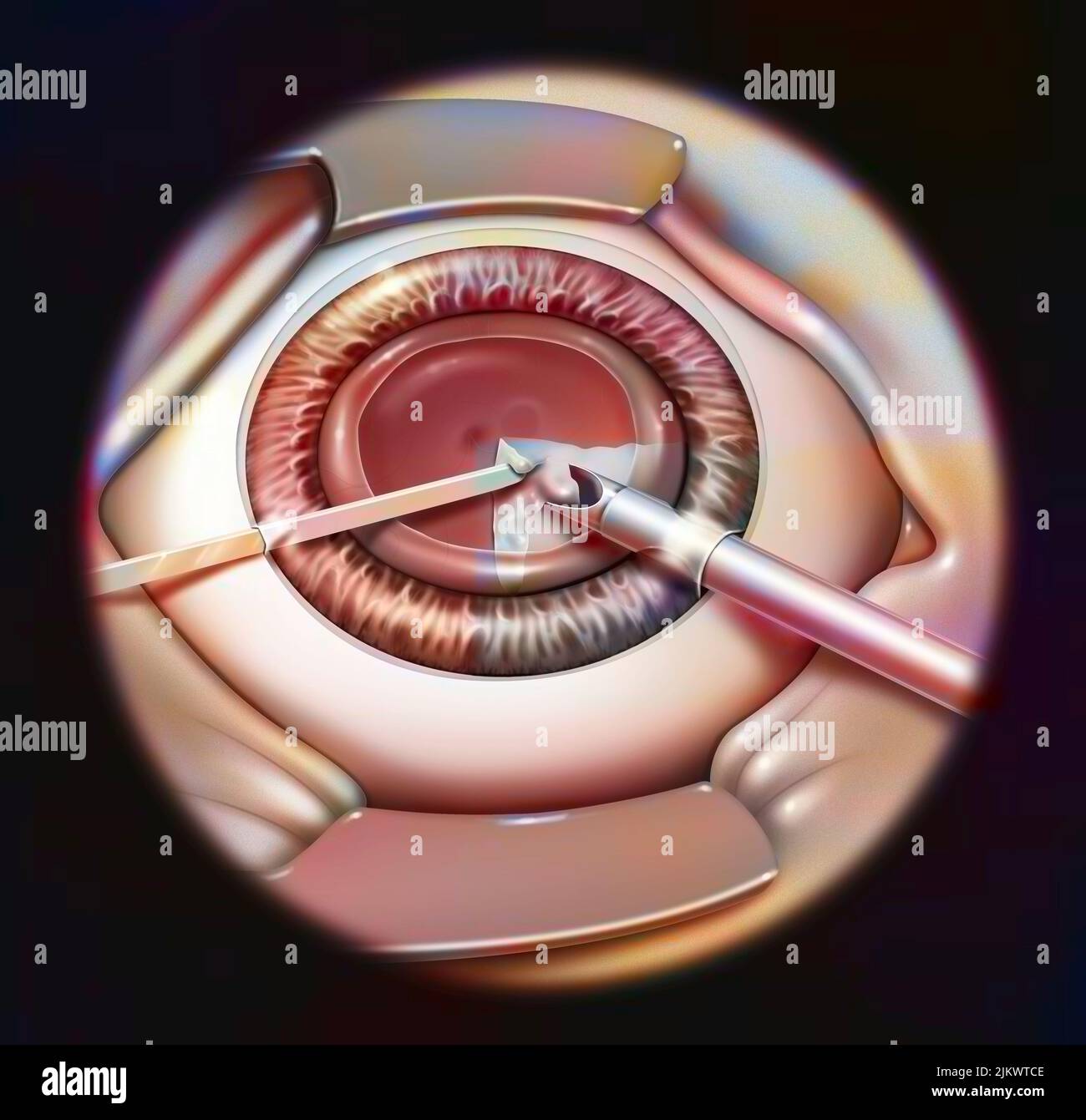 Eye, cataract, phacoemulsification - step 2: consists of breaking the lens with a probe. Stock Photo