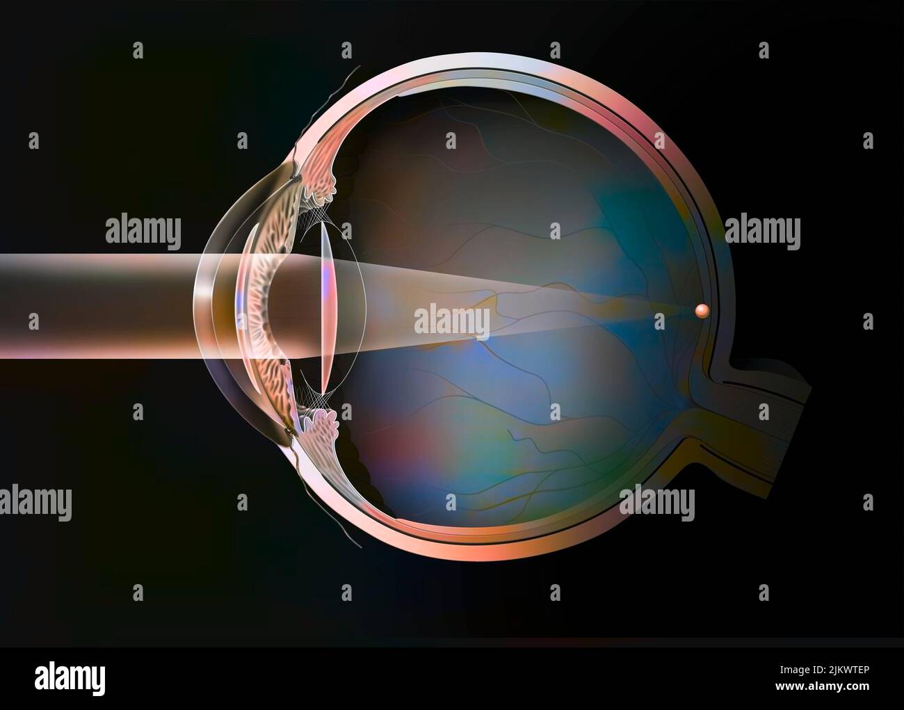 Eye, cataract intraocular implants in anterior and posterior chamber Stock Photo Alamy