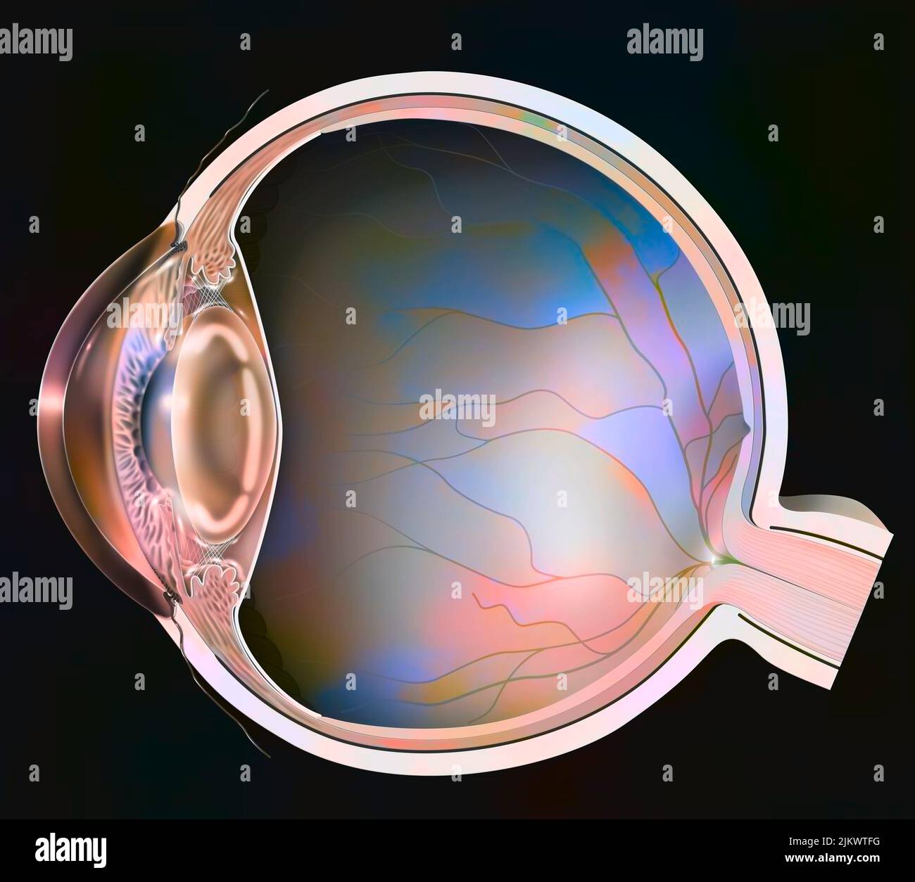 Eye clouding of the lens in the event of cortical cataracts Stock