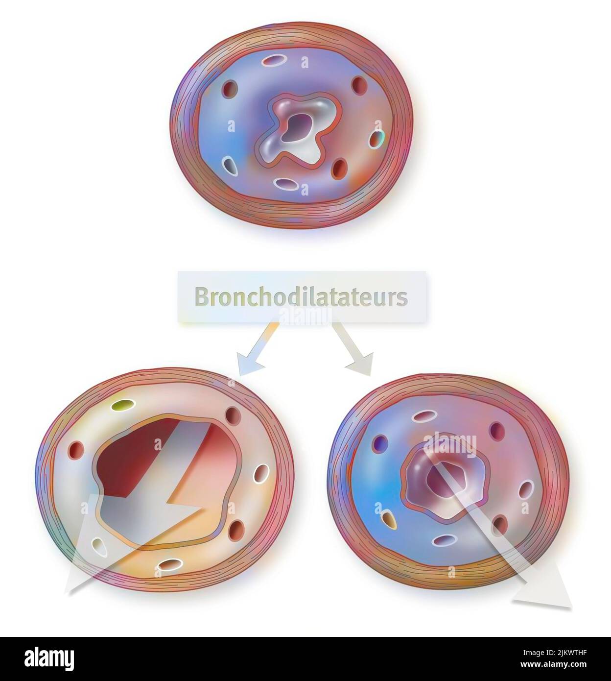 Effect of the bronchodilator on a bronchus with an asthma attack (left) and COPD (right). Stock Photo