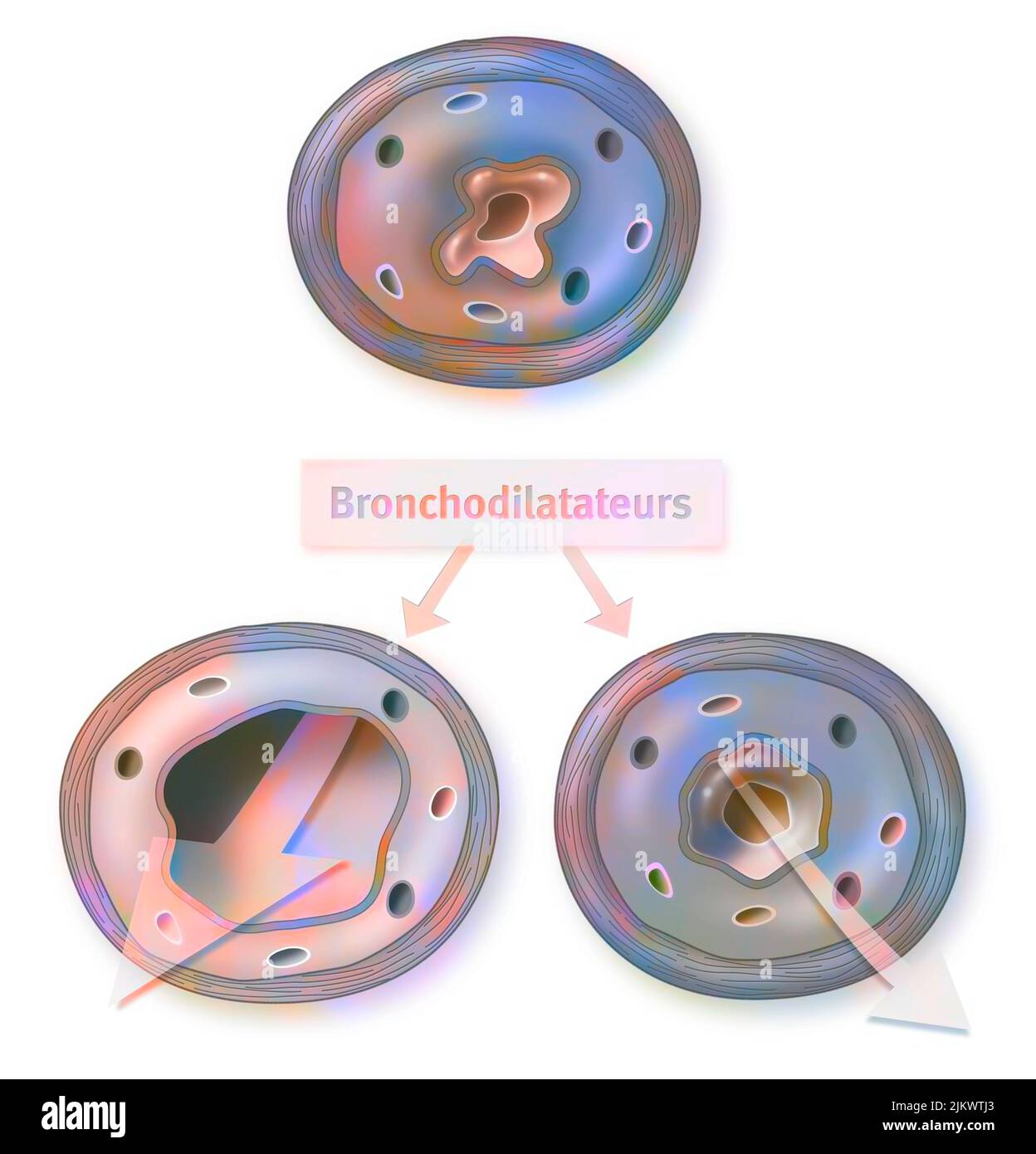 Effect of the bronchodilator on a bronchus with an asthma attack (left) and COPD (right). Stock Photo