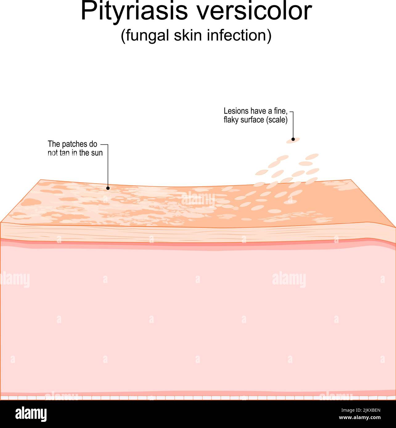 Pityriasis versicolor. fungal skin infection. Cross section of a human