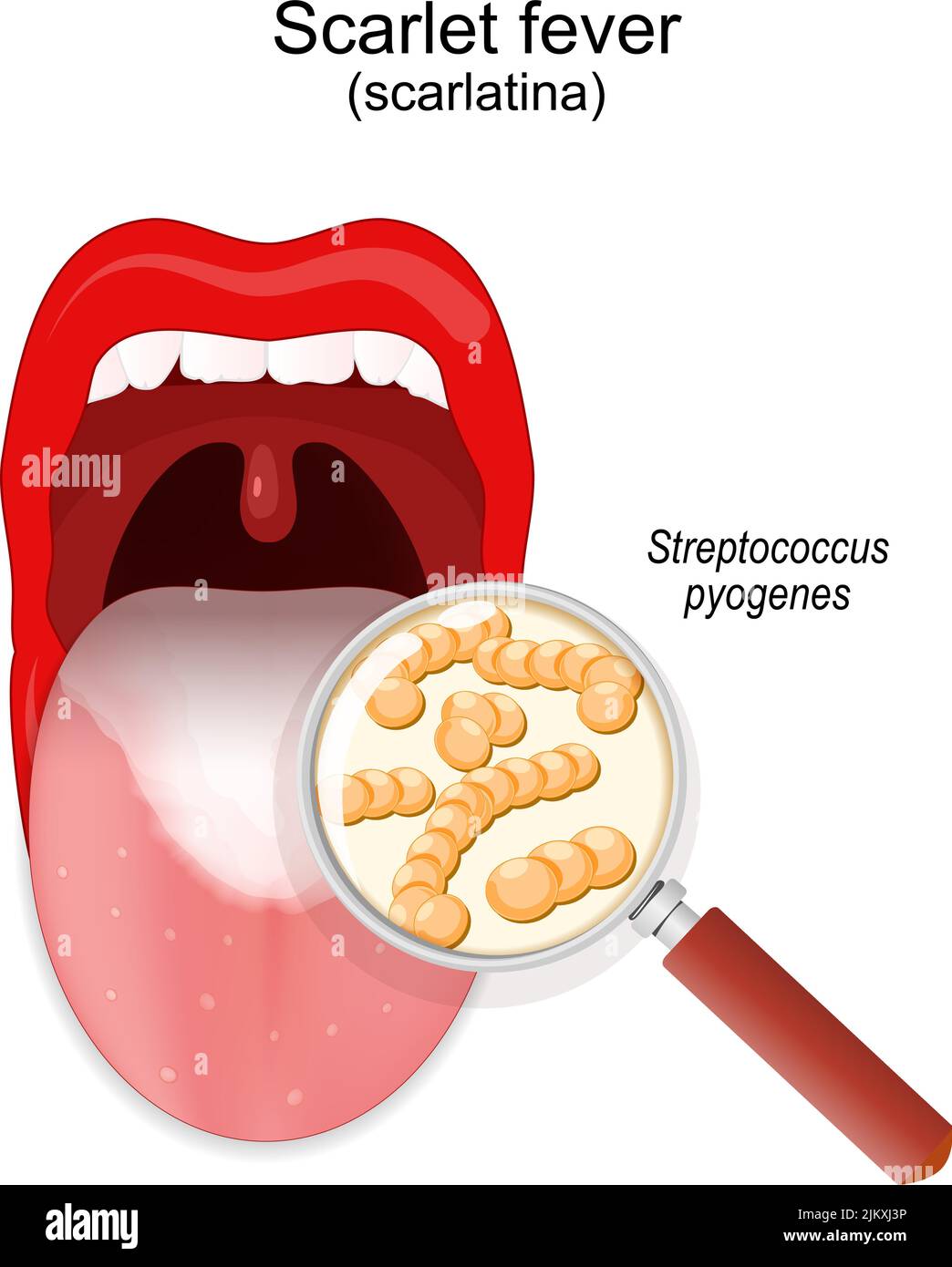 Scarlet fever. Children's mouth with symptoms of disease on a tongue. Close-up of colony of Streptococcus pyogenes. magnifying glass and bacteria Stock Vector