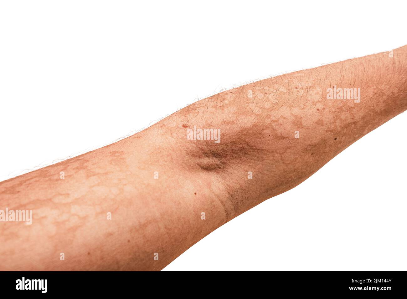 Isolated man hand with a fungal dermatological skin disease. Symptoms of severe scratching and exfoliation of the epidermis Stock Photo