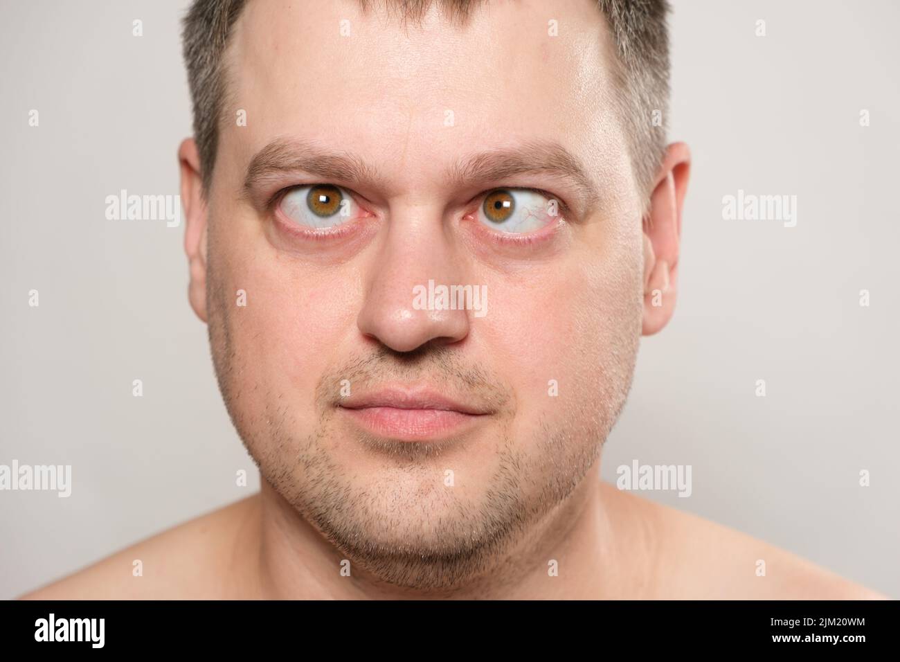 A man with strabismus squints his eyes on a white background. Stock Photo