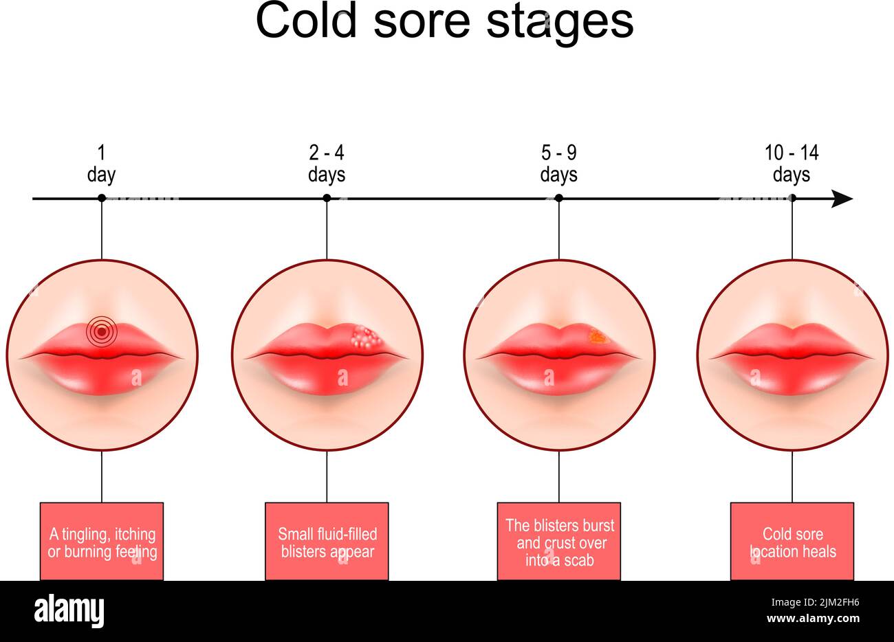 Cold sore stages. Lips with symptoms of Herpes labialis. scale From burning feeling to blisters formation and Cold sore location heals. vector Stock Vector