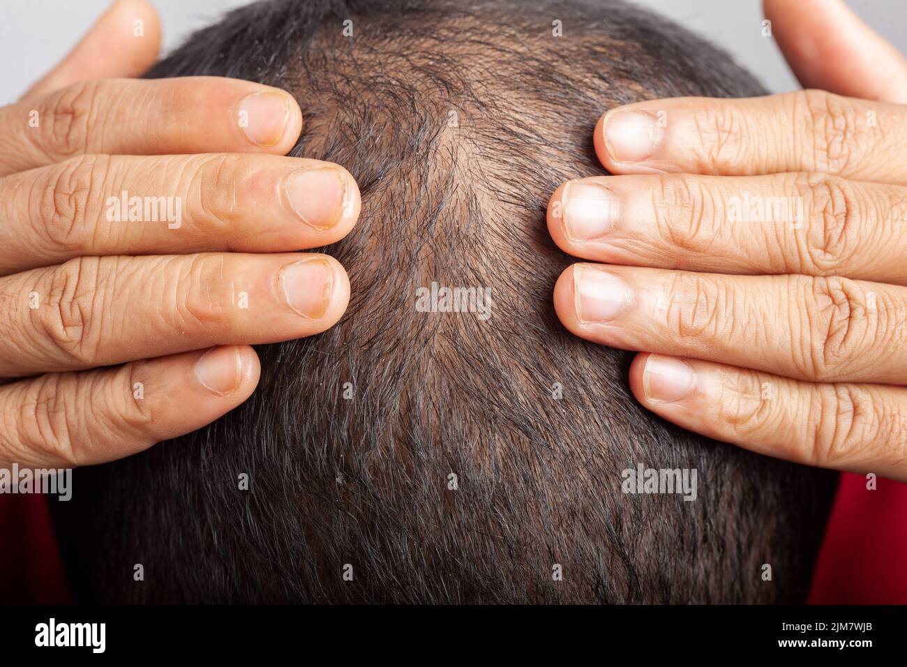 young male touching his head showing bald spot on head suffering from