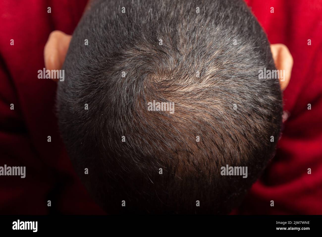 Man showing bald patches on the top of scalp suffering from androgenic
