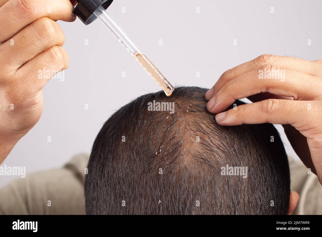 minoxidil oil, Caucasian male using hair growth oil by a dropper on