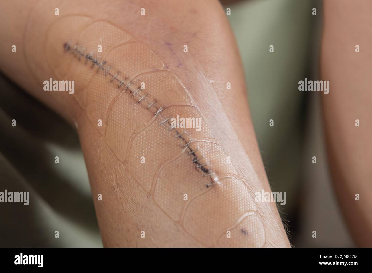 Metal staples or stitches over a fresh wound after knee surgery. Wound and stitches covered with plastic self adhesive safety cover to prevent bruises Stock Photo