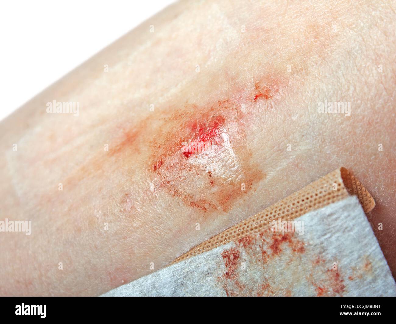 Wound Stock Photo