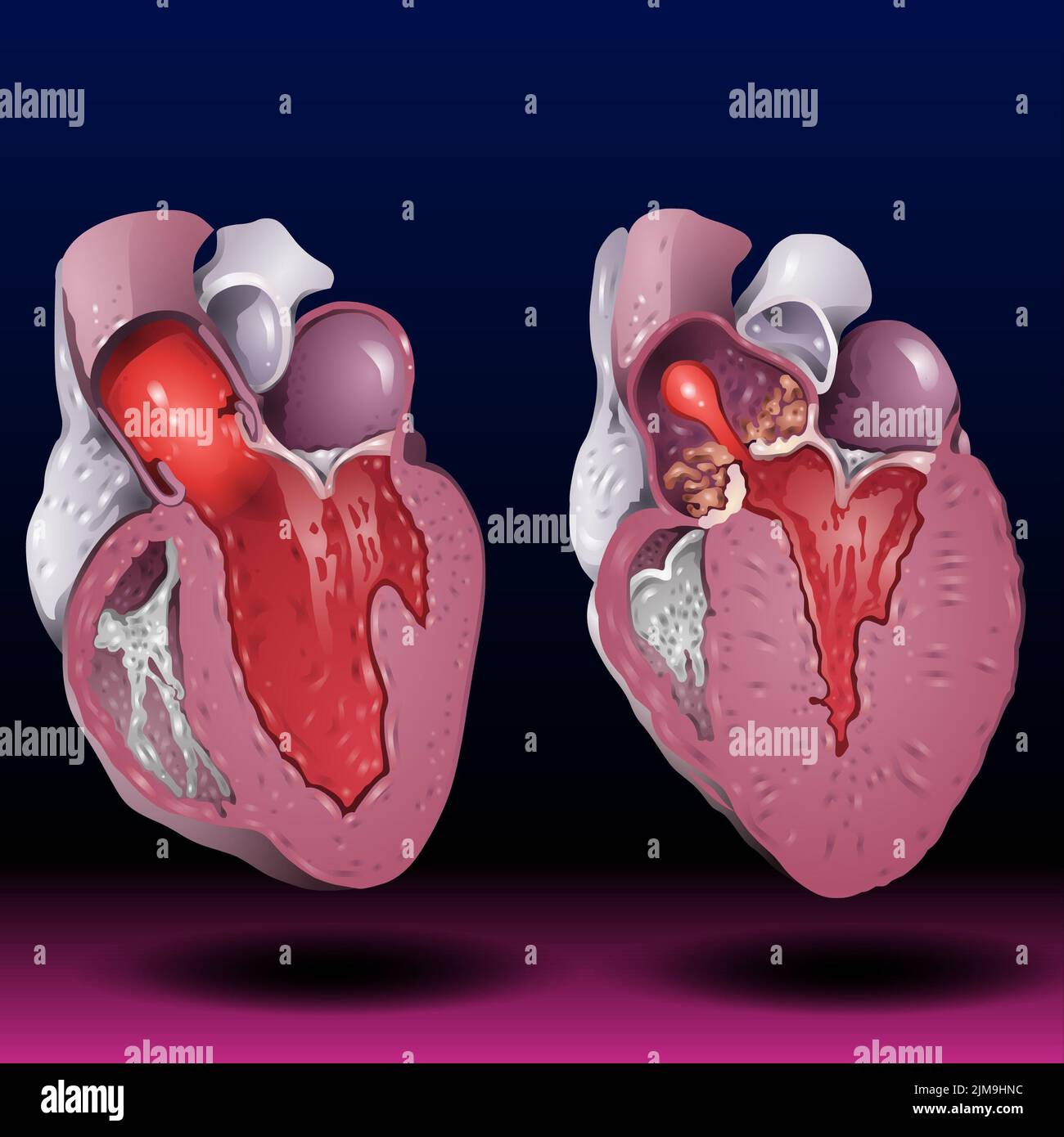 Human heart. Anatomical muscular human pumps blood organ, cutaway