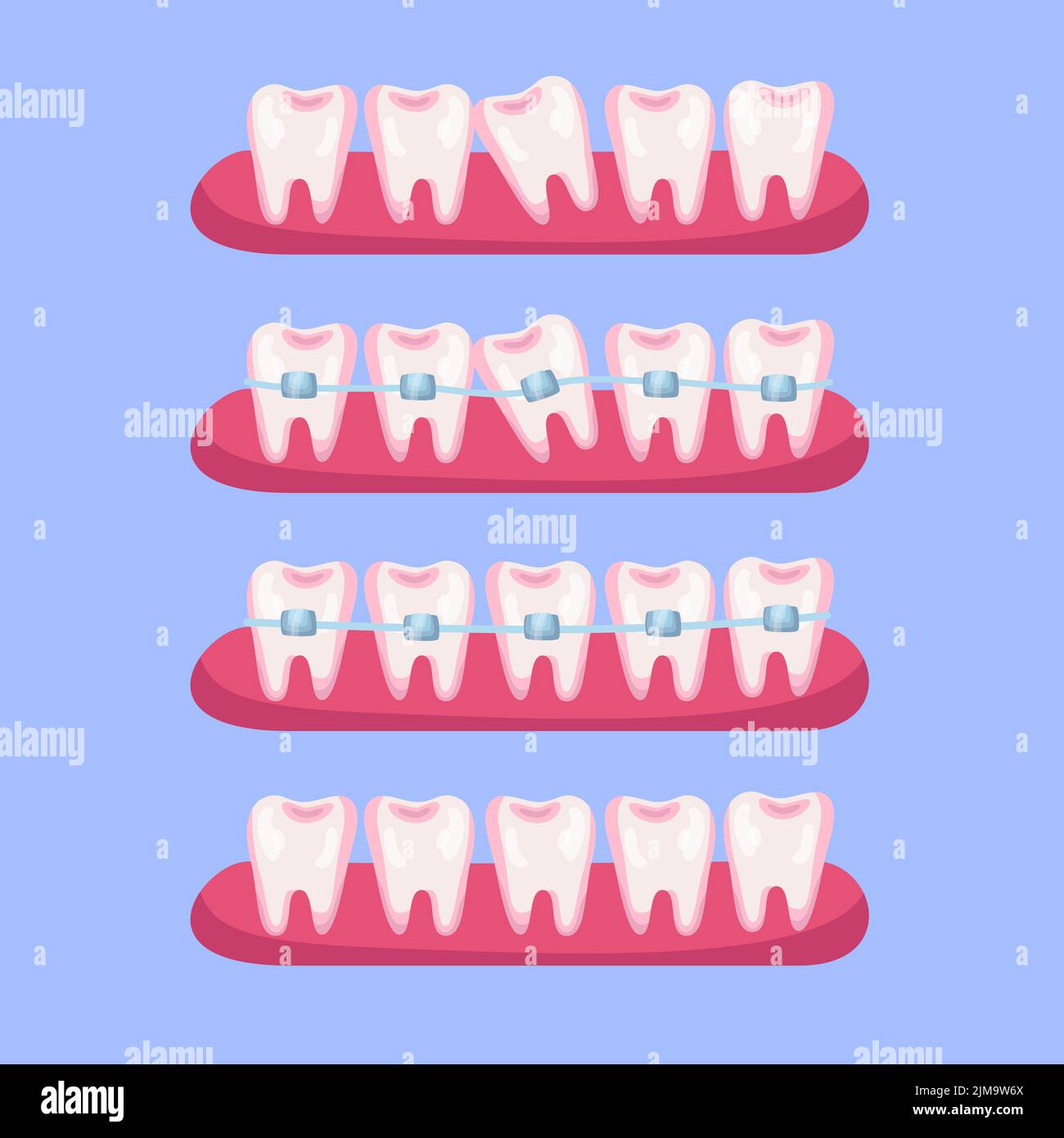 Teeth before and after braces cartoon illustration set. Stages of