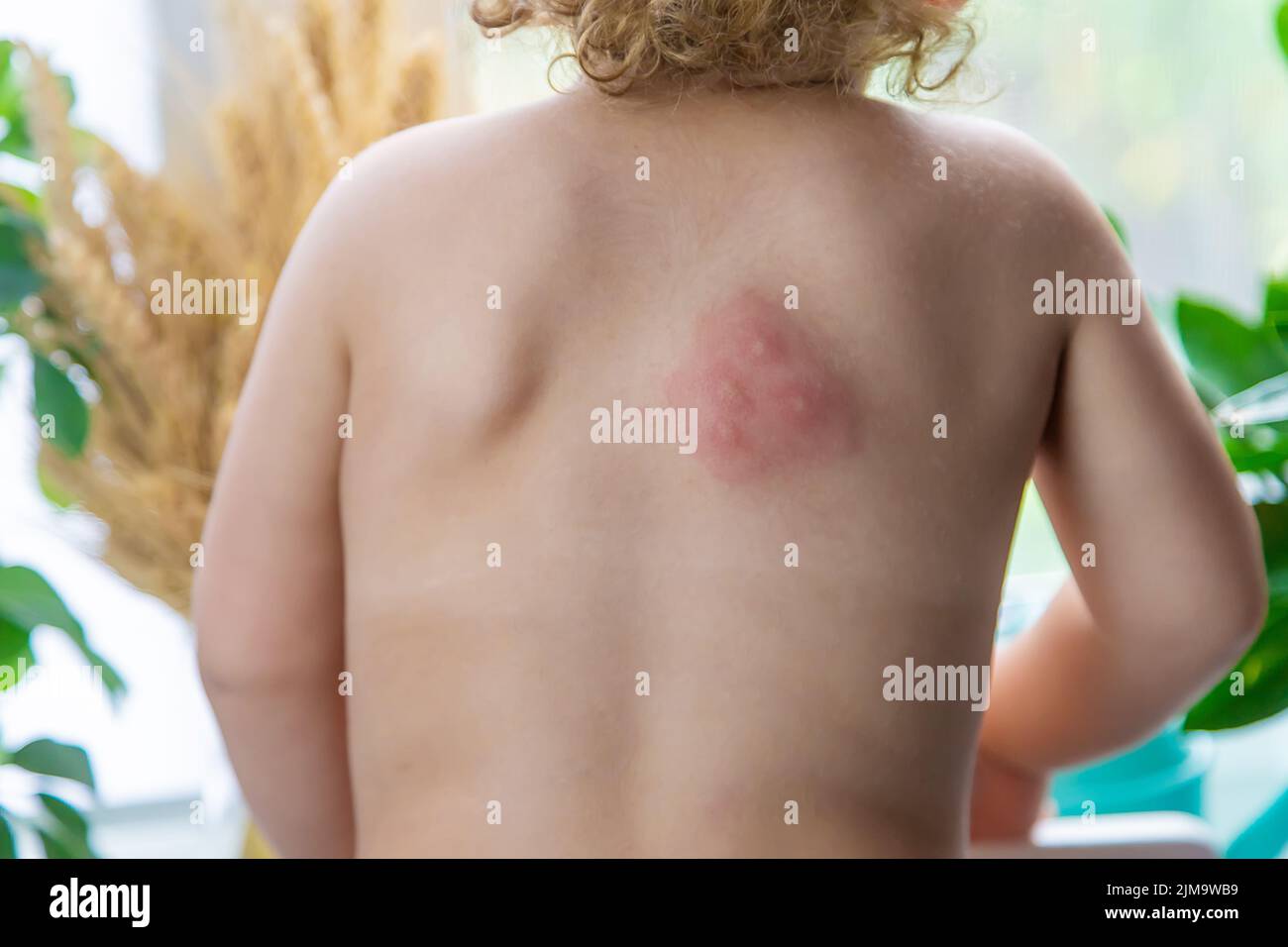 Mosquito bites on a child back. Selective focus. Kid. Stock Photo