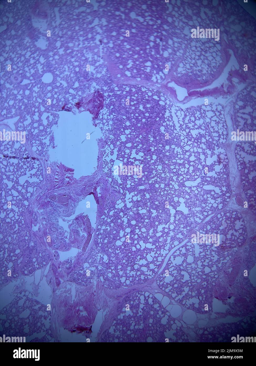 Lung tissue histology in the mobile microscopic view. H and E staining. Pink purple color. Neutrophil infiltration with a background of pneumonia. Stock Photo