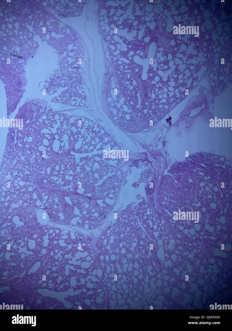 Lung tissue histology in the mobile microscopic view. H and E staining. Pink purple color. Neutrophil infiltration with a background of pneumonia. Stock Photo