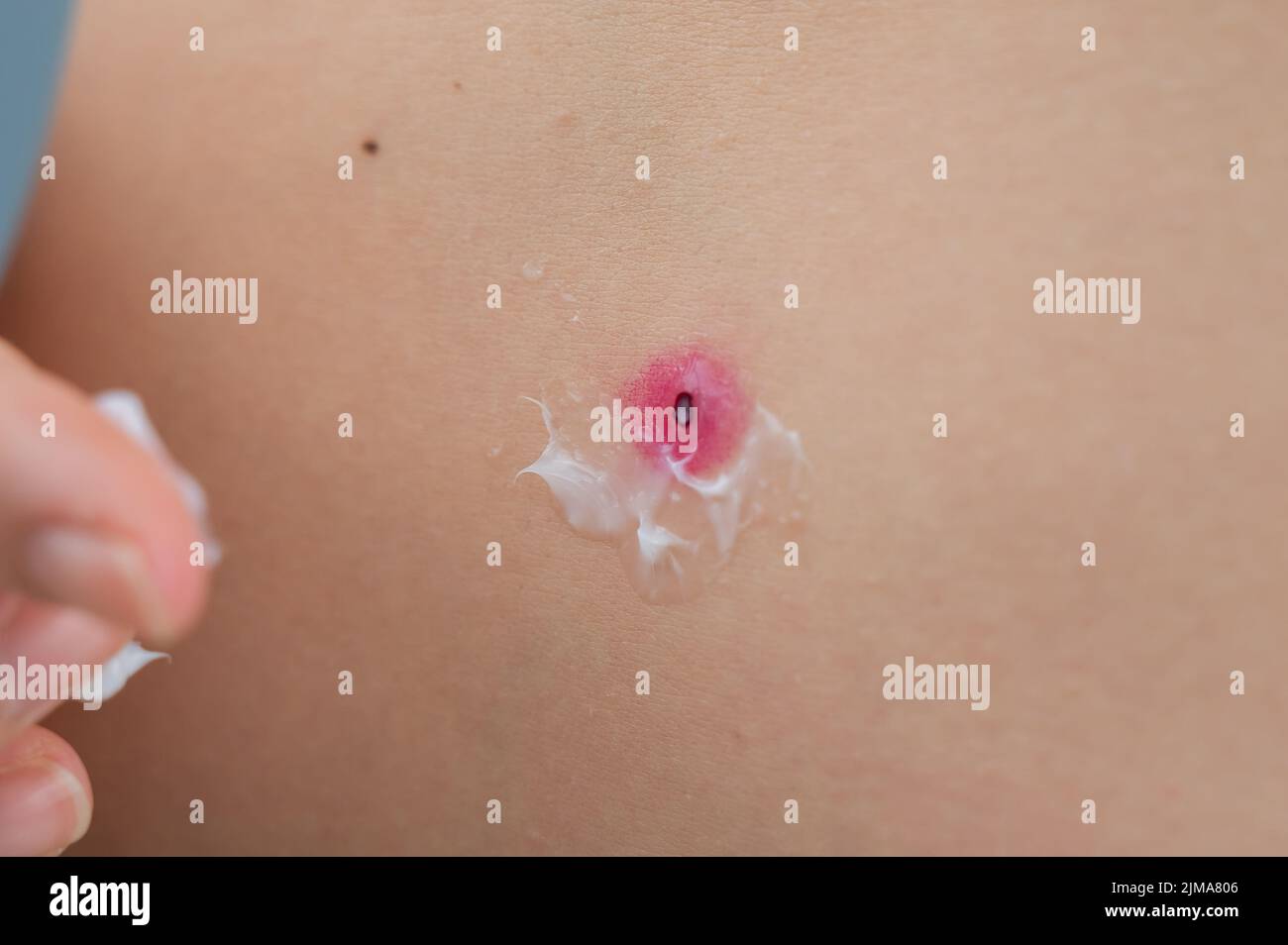 A woman smears cream on a wound after burning a wart.  Stock Photo