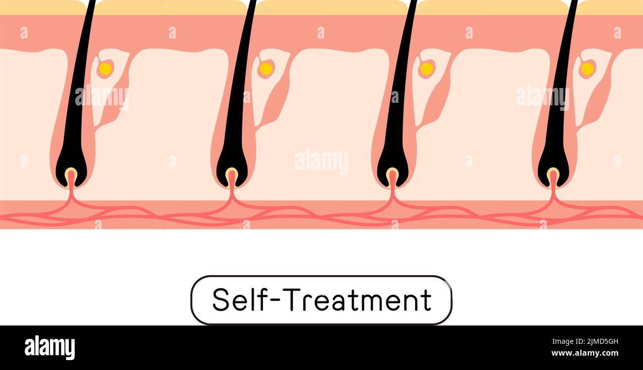 Image of hair removal, after hair removal, self-treated Stock Vector