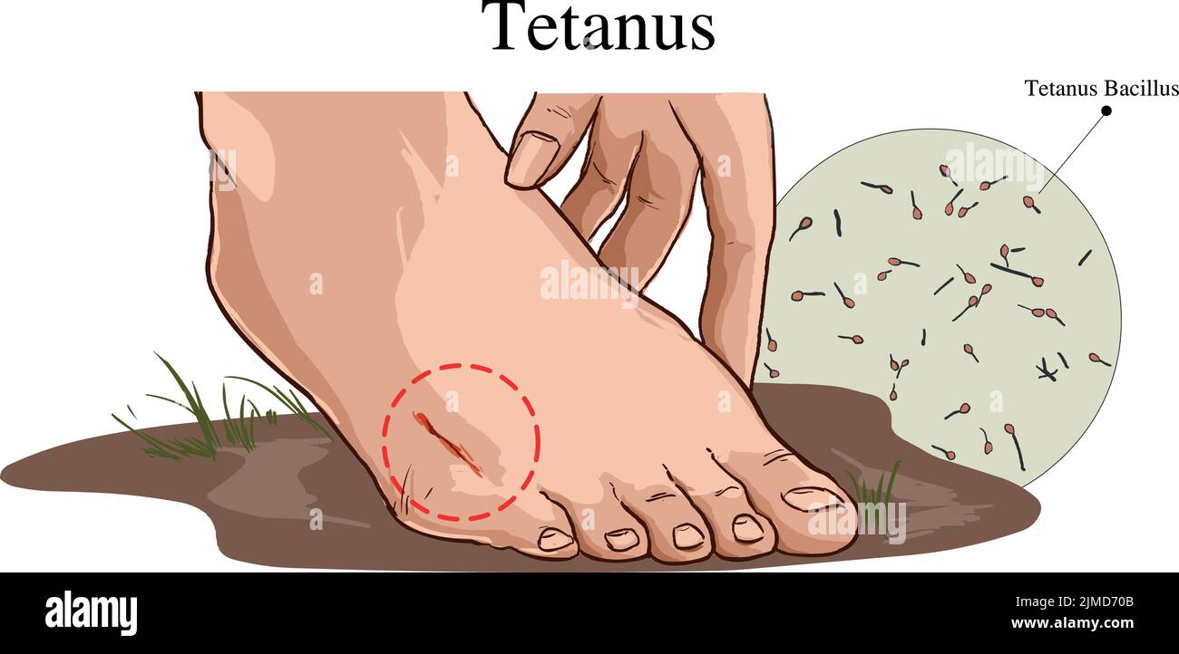 Damage to the feet. the risk of tetanus Stock Vector