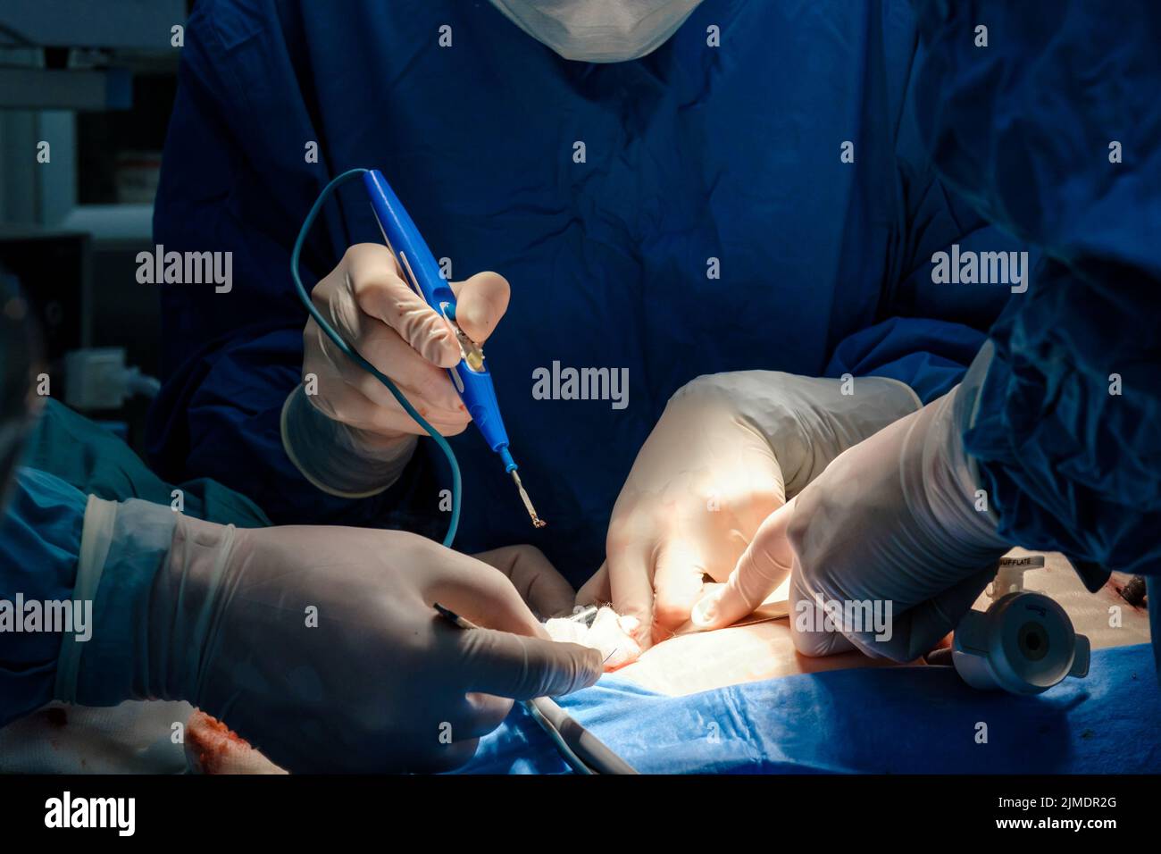 The surgeon holds the electrical coagulator during the operation Stock