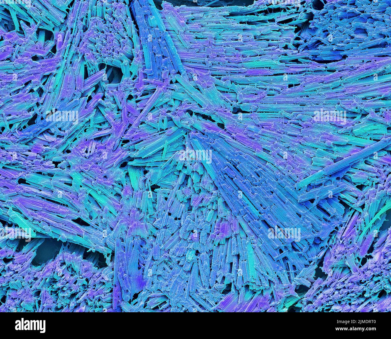 Uric acid crystals in gout, SEM Stock Photo