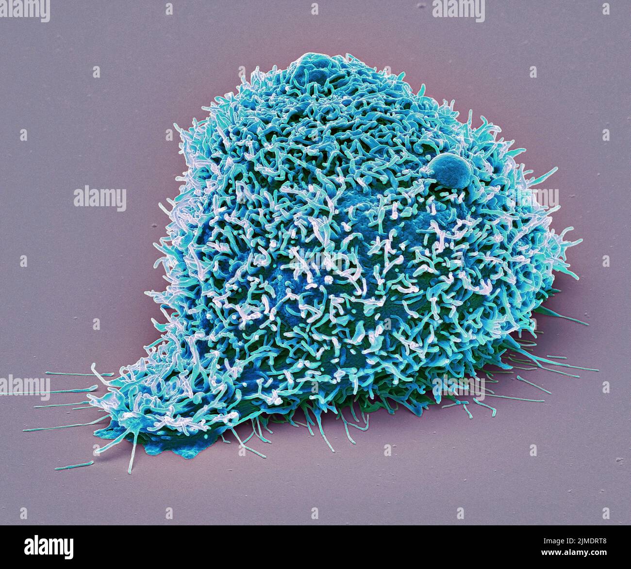Kidney cancer cell. Coloured scanning electron micrograph (SEM) of a Kidney carcinoma cell. Cancer cells divide rapidly in a chaotic manner and may cl Stock Photo