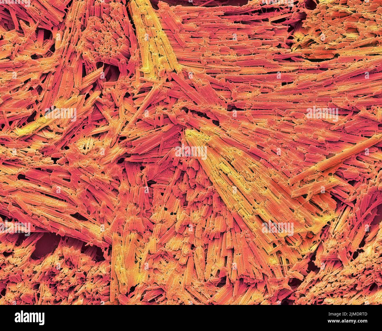 Uric acid crystals in gout, SEM Stock Photo